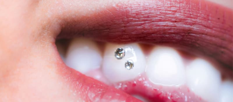 Bijoux dentaires (strass) collés sur les incisives d’une personne, illustrant la tendance esthétique risquée pouvant causer fractures, infections ou perte d’émail.