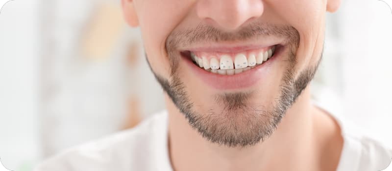 Dents noires : causes et solutions Apprenez à prévenir et traiter les taches dentaires
